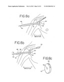 Resurfacing implant for a humeral head diagram and image