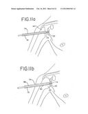 Resurfacing implant for a humeral head diagram and image