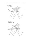 Resurfacing implant for a humeral head diagram and image