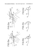 Resurfacing implant for a humeral head diagram and image