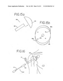 Resurfacing implant for a humeral head diagram and image