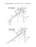 Resurfacing implant for a humeral head diagram and image