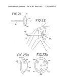 Resurfacing implant for a humeral head diagram and image