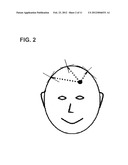 INSERTION OF MEDICAL DEVICES THROUGH NON-ORTHOGONAL AND ORTHOGONAL     TRAJECTORIES WITHIN THE CRANIUM AND METHODS OF USING diagram and image