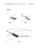 INSERTION OF MEDICAL DEVICES THROUGH NON-ORTHOGONAL AND ORTHOGONAL     TRAJECTORIES WITHIN THE CRANIUM AND METHODS OF USING diagram and image