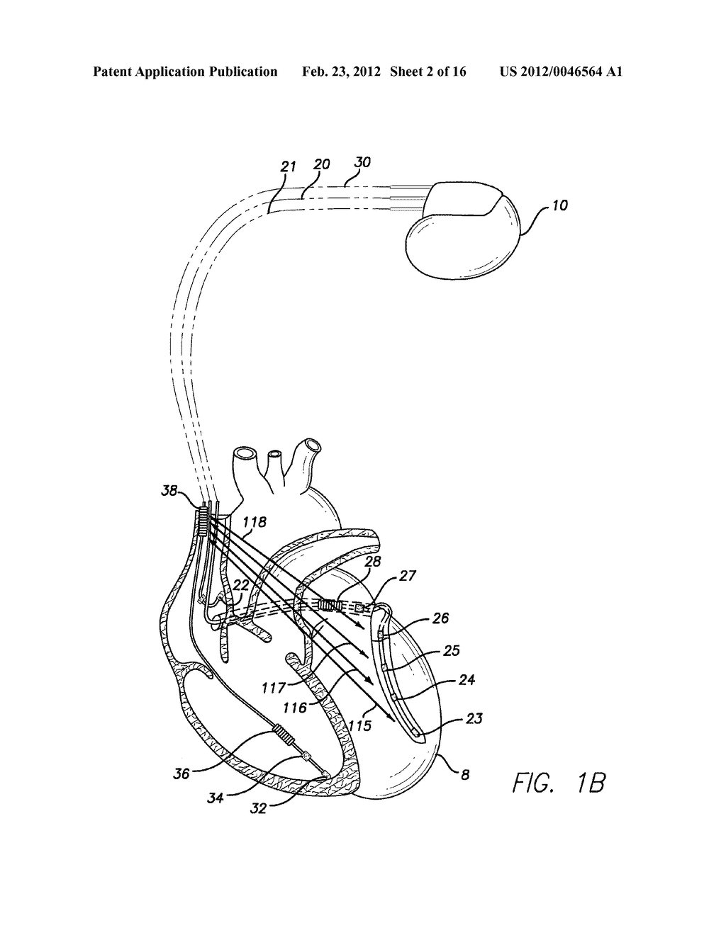 METHODS AND SYSTEMS TO MONITOR AND IDENTIFY TRANSIENT ISCHEMIA - diagram, schematic, and image 03