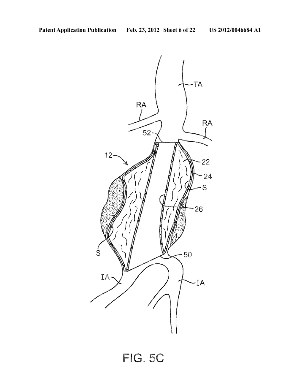 Graft Systems Having Filling Structures Supported by Scaffolds and Methods     for Their Use - diagram, schematic, and image 07