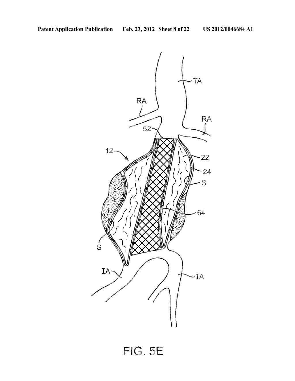 Graft Systems Having Filling Structures Supported by Scaffolds and Methods     for Their Use - diagram, schematic, and image 09
