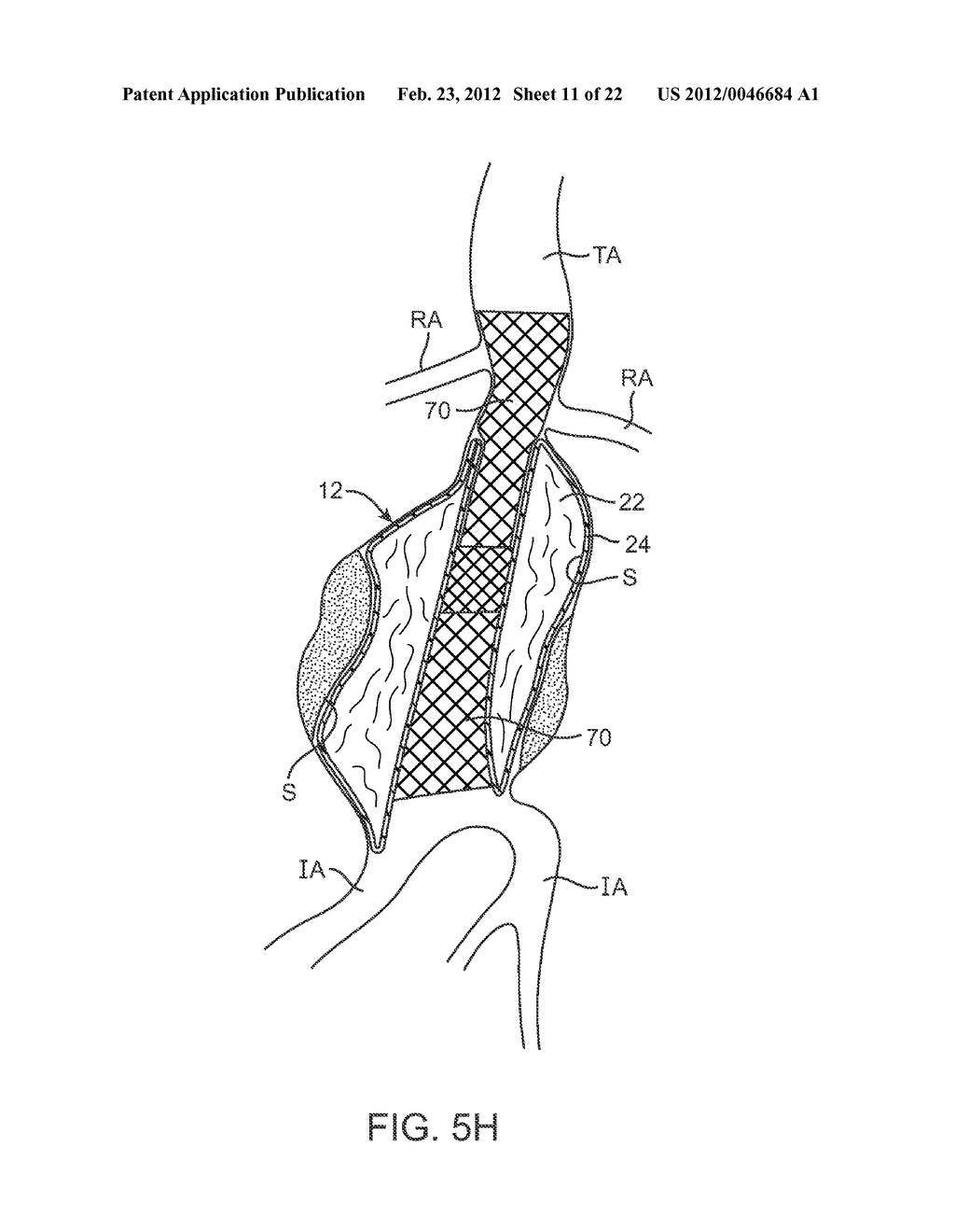 Graft Systems Having Filling Structures Supported by Scaffolds and Methods     for Their Use - diagram, schematic, and image 12