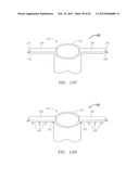 Clip-Based Systems and Methods for Treating Septal Defects diagram and image