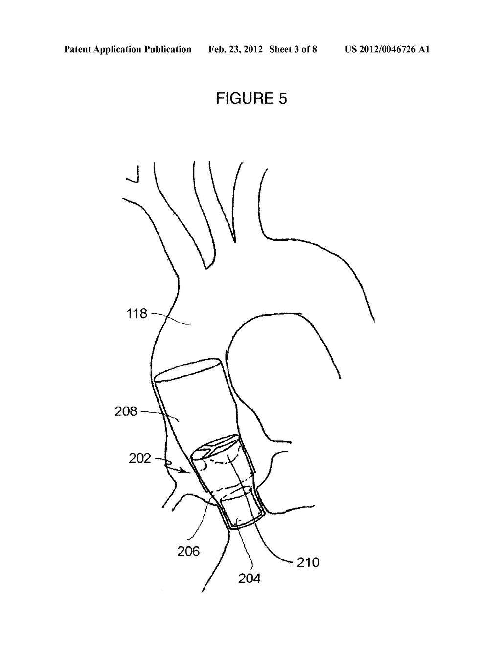 AORTIC VALVE STENT GRAFT - diagram, schematic, and image 04