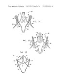 Valve Prosthesis Fixation Techniques Using Sandwiching diagram and image