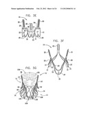 Valve Prosthesis Fixation Techniques Using Sandwiching diagram and image