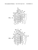 Valve Prosthesis Fixation Techniques Using Sandwiching diagram and image