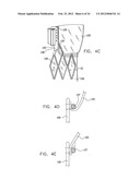 Valve Prosthesis Fixation Techniques Using Sandwiching diagram and image