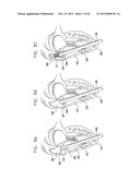 Valve Prosthesis Fixation Techniques Using Sandwiching diagram and image