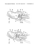 Valve Prosthesis Fixation Techniques Using Sandwiching diagram and image