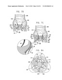 Valve Prosthesis Fixation Techniques Using Sandwiching diagram and image