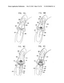 Valve Prosthesis Fixation Techniques Using Sandwiching diagram and image