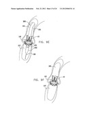 Valve Prosthesis Fixation Techniques Using Sandwiching diagram and image