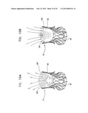 Valve Prosthesis Fixation Techniques Using Sandwiching diagram and image