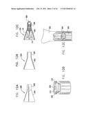 Valve Prosthesis Fixation Techniques Using Sandwiching diagram and image