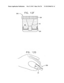 Valve Prosthesis Fixation Techniques Using Sandwiching diagram and image