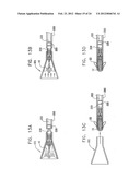 Valve Prosthesis Fixation Techniques Using Sandwiching diagram and image