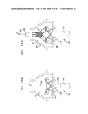 Valve Prosthesis Fixation Techniques Using Sandwiching diagram and image