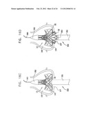 Valve Prosthesis Fixation Techniques Using Sandwiching diagram and image