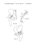 APPARATUS FOR CONTROLLING A LOAD ON A HIP JOINT diagram and image