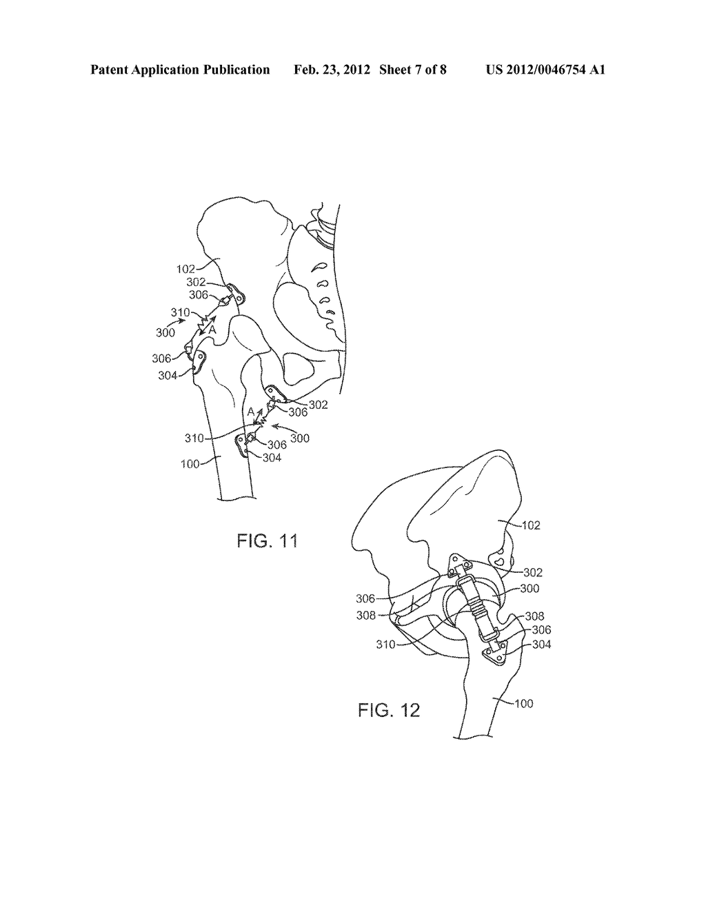 APPARATUS FOR CONTROLLING A LOAD ON A HIP JOINT - diagram, schematic, and image 08