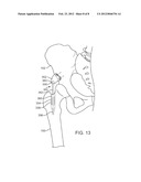 APPARATUS FOR CONTROLLING A LOAD ON A HIP JOINT diagram and image