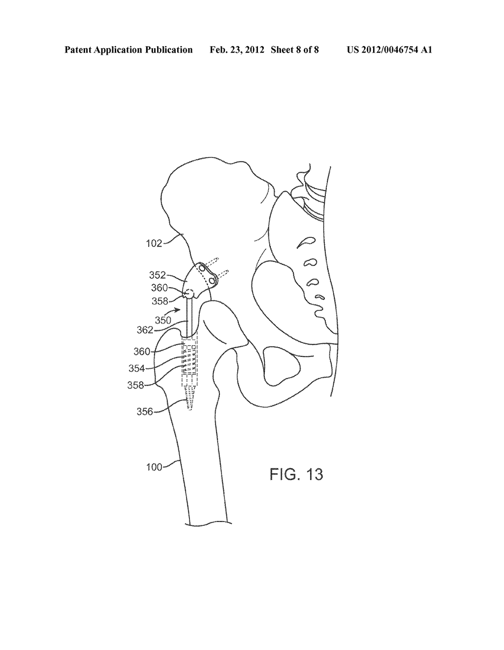 APPARATUS FOR CONTROLLING A LOAD ON A HIP JOINT - diagram, schematic, and image 09