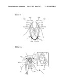 CENTERING AID FOR IMPLANTABLE SLING diagram and image