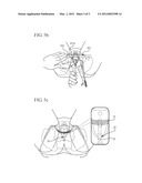 CENTERING AID FOR IMPLANTABLE SLING diagram and image