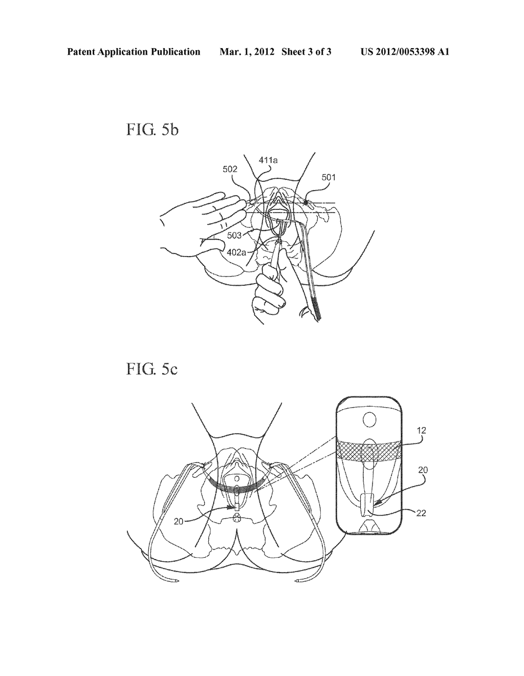 CENTERING AID FOR IMPLANTABLE SLING - diagram, schematic, and image 04