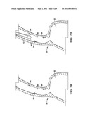 Ablation Overtube diagram and image