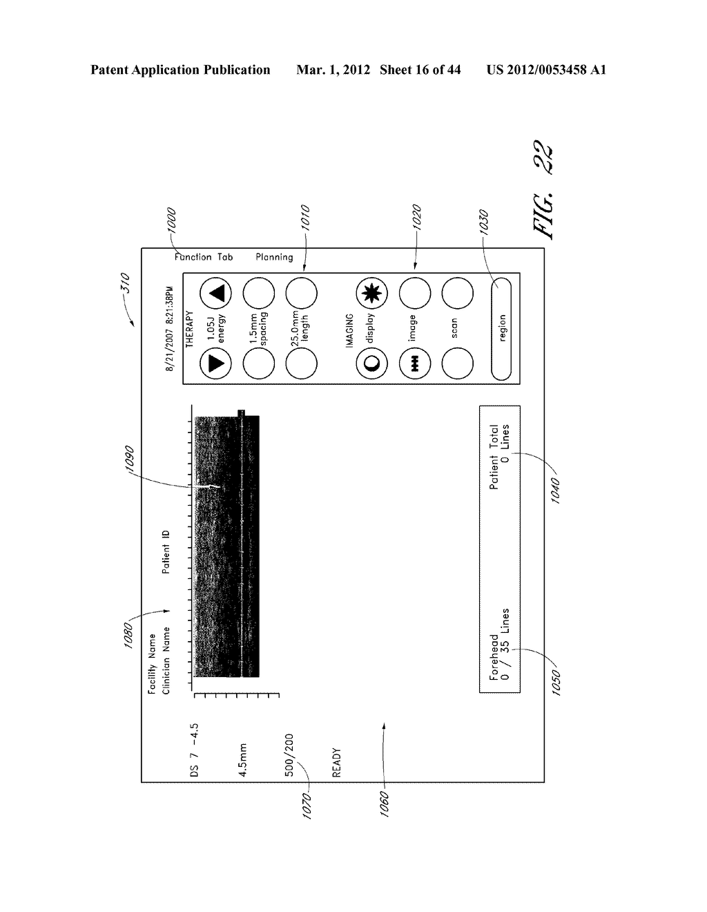 Methods For Non-Invasive Lifting And Tightening Of The Lower Face And Neck - diagram, schematic, and image 17