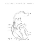 TISSUE CHARACTERIZATION USING INTRACARDIAC IMPEDANCES WITH AN IMPLANTABLE     LEAD SYSTEM diagram and image