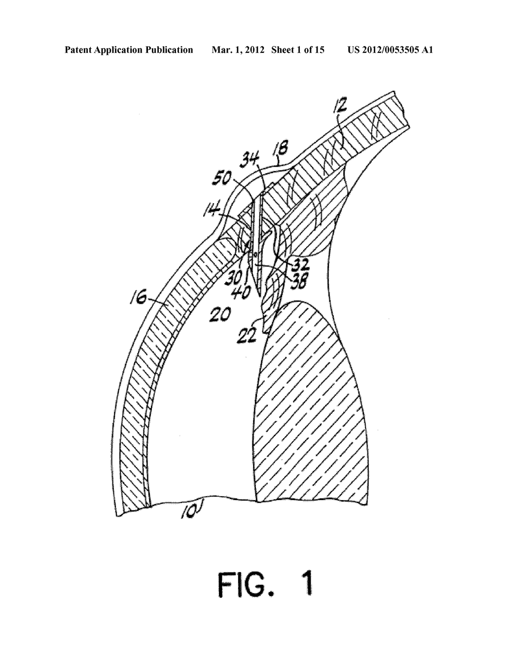 FLOW REGULATING IMPLANT, METHOD OF MANUFACTURE, AND DELIVERY DEVICE - diagram, schematic, and image 02