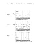 Apparatus and Method for Periodic Fluid-Delivery/Fluid-Removal Cycles in     the Cranial Subarchnoid Space to Treat Cerebral Cortical Disorders diagram and image