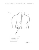 THERAPY FOR RAPID EYE MOVEMENT BEHAVIOR DISORDER (RBD) diagram and image