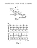 Treatment of Cardiac Arrhythmia by Modification of Neuronal Signaling     Through Fat Pads of the Heart diagram and image