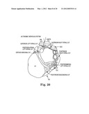 Treatment of Cardiac Arrhythmia by Modification of Neuronal Signaling     Through Fat Pads of the Heart diagram and image