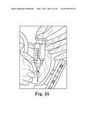 Treatment of Cardiac Arrhythmia by Modification of Neuronal Signaling     Through Fat Pads of the Heart diagram and image