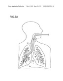 METHOD FOR TREATMENT OF EMPHYSEMA diagram and image