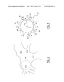 Ablation Catheter and Method for Electrically Isolating Cardiac Tissue diagram and image