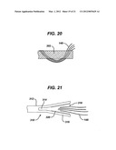 KNOTLESS SUTURE ANCHOR WITH UNTHREADED NOSE diagram and image