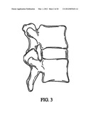 System and Method for Replacement of Spinal Motion Segment diagram and image